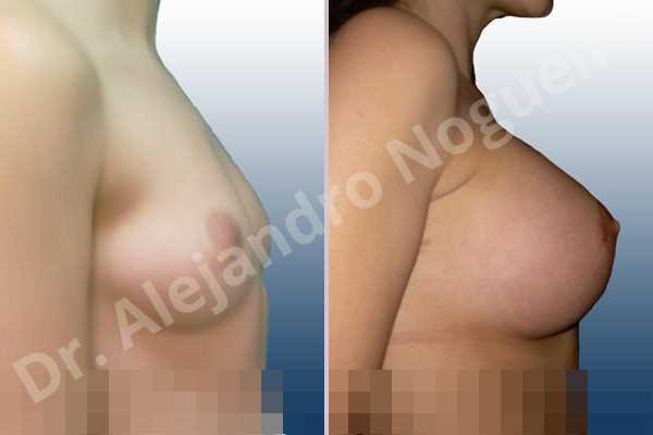 Asymmetric breasts,Cross eyed breasts,Lateral breasts,Small breasts,Too far apart wide cleavage breasts,Round shape,Lower hemi periareolar incision,Subfascial pocket plane - photo 3