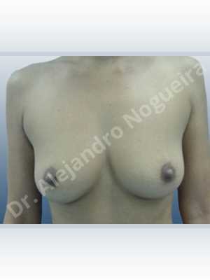 Cross eyed breasts,Empty breasts,Moderately saggy droopy breasts,Small breasts,Anatomical shape,Lower hemi periareolar incision,Subfascial pocket plane