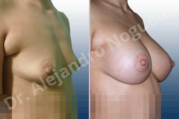 Asymmetric breasts,Cross eyed breasts,Empty breasts,Lateral breasts,Slightly saggy droopy breasts,Small breasts,Too far apart wide cleavage breasts,Tuberous breasts,Anatomical shape,Lower hemi periareolar incision,Subfascial pocket plane,Tuberous mammoplasty - photo 3