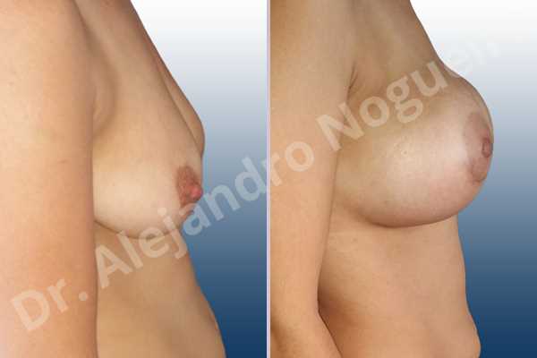 Empty breasts,Lateral breasts,Pendulous breasts,Severely saggy droopy breasts,Skinny breasts,Slightly large breasts,Too far apart wide cleavage breasts,Lower hemi periareolar incision,Round shape,Subfascial pocket plane - photo 4
