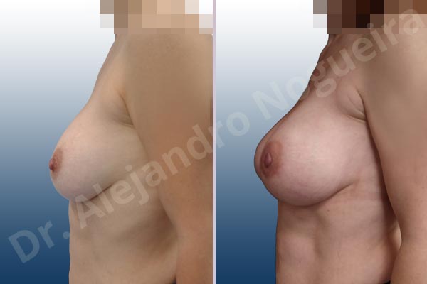 Asymmetric breasts,Breast implants bottoming out,Breast implants excessive movement,Breast implants lateral slide,Empty breasts,Mildly saggy droopy breasts,Slightly saggy droopy breasts,Small breasts,Too far apart wide cleavage breast implants,Too narrow breast implants,Anatomical shape,Capsulectomy,Extra large size,Lower hemi periareolar incision,Subfascial pocket plane - photo 2