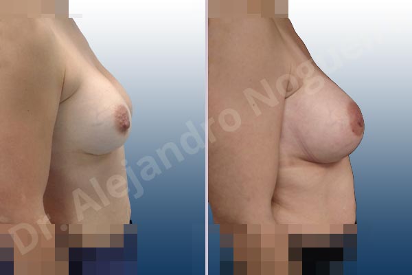 Asymmetric breasts,Breast implants bottoming out,Breast implants excessive movement,Breast implants lateral slide,Empty breasts,Mildly saggy droopy breasts,Slightly saggy droopy breasts,Small breasts,Too far apart wide cleavage breast implants,Too narrow breast implants,Anatomical shape,Capsulectomy,Extra large size,Lower hemi periareolar incision,Subfascial pocket plane - photo 4