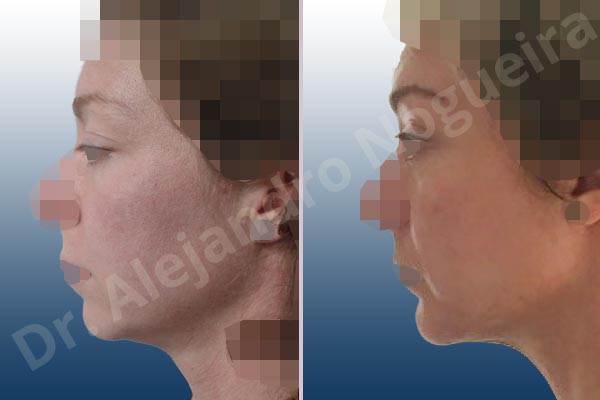 Deep nasolabial folds,Droopy cheeks,Droopy eyebrows,Droopy face,Droopy forehead,Small chin,Upper eyelids ptosis,Weak chin,Horizontal chin osteotomy,One dimensional genioplasty,Osseous chin advancement,Short temporal incisions supraperiosteal extended lift of the upper two thirds of the face - photo 2