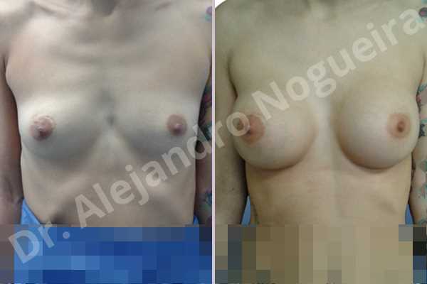 Empty breasts,Narrow breasts,Skinny breasts,Small breasts,Sunken chest,Too far apart wide cleavage breasts,Anatomical shape,Inframammary incision,Subfascial pocket plane - photo 1