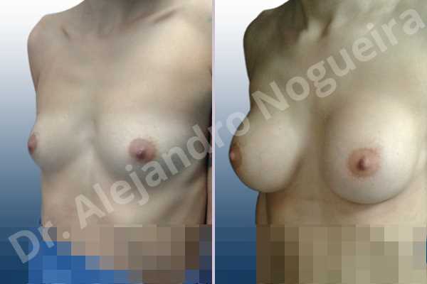 Empty breasts,Narrow breasts,Skinny breasts,Small breasts,Sunken chest,Too far apart wide cleavage breasts,Anatomical shape,Inframammary incision,Subfascial pocket plane - photo 3