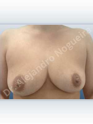Asymmetric breasts,Empty breasts,Mildly saggy droopy breasts,Small breasts,Wide breasts,Tuberous breasts,Anatomical shape,Lollipop incision,Subfascial pocket plane,Superior pedicle