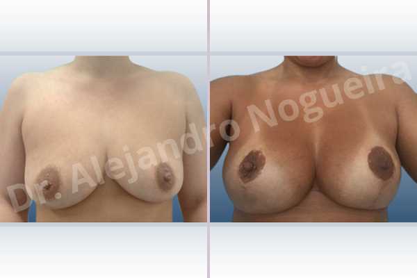 Asymmetric breasts,Empty breasts,Mildly saggy droopy breasts,Small breasts,Wide breasts,Tuberous breasts,Anatomical shape,Lollipop incision,Subfascial pocket plane,Superior pedicle - photo 1