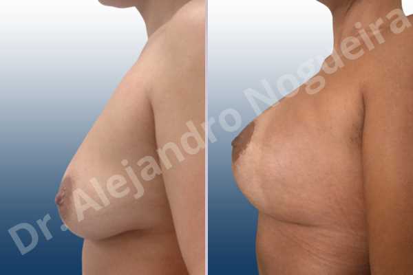 Asymmetric breasts,Empty breasts,Mildly saggy droopy breasts,Small breasts,Wide breasts,Tuberous breasts,Anatomical shape,Lollipop incision,Subfascial pocket plane,Superior pedicle - photo 2