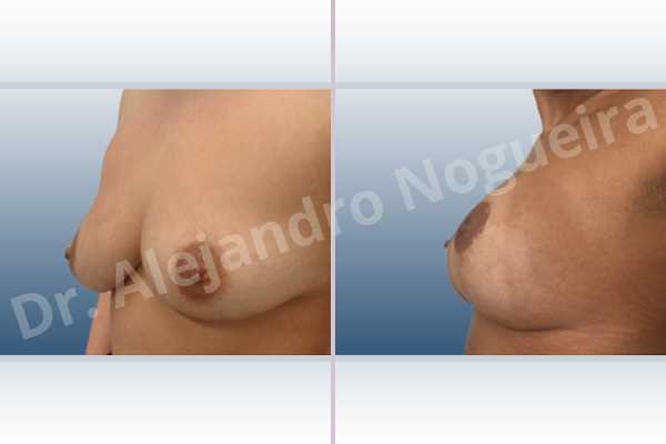 Asymmetric breasts,Empty breasts,Mildly saggy droopy breasts,Small breasts,Wide breasts,Tuberous breasts,Anatomical shape,Lollipop incision,Subfascial pocket plane,Superior pedicle - photo 3