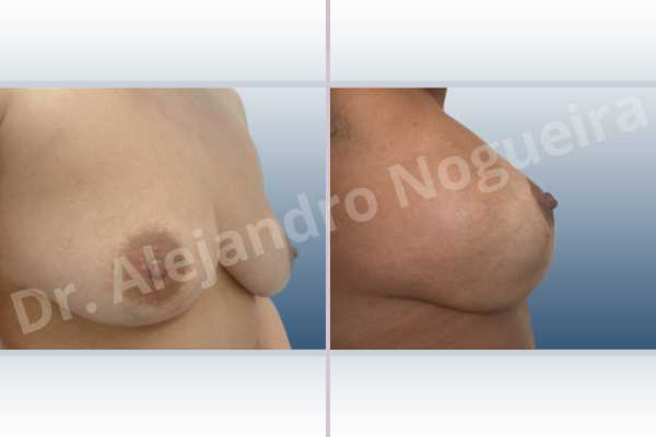 Asymmetric breasts,Empty breasts,Mildly saggy droopy breasts,Small breasts,Wide breasts,Tuberous breasts,Anatomical shape,Lollipop incision,Subfascial pocket plane,Superior pedicle - photo 5