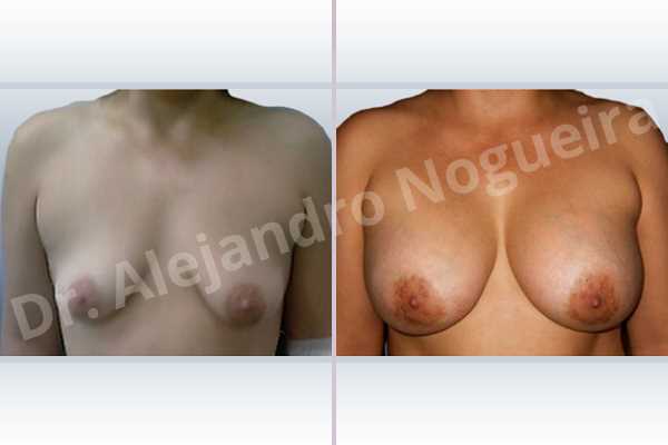 Asymmetric breasts,Empty breasts,Moderately saggy droopy breasts,Narrow breasts,Pendulous breasts,Severely saggy droopy breasts,Small breasts,Sunken chest,Too far apart wide cleavage breasts,Tuberous breasts,Anatomical shape,Lower hemi periareolar incision,Subfascial pocket plane,Tuberous mammoplasty - photo 1