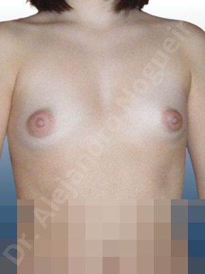 Asymmetric breasts,Cross eyed breasts,Lateral breasts,Narrow breasts,Skinny breasts,Small breasts,Sunken chest,Too far apart wide cleavage breasts,Tuberous breasts,Anatomical shape,Lower hemi periareolar incision,Subfascial pocket plane,Tuberous mammoplasty