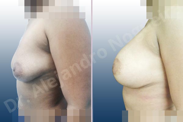 Asymmetric breasts,Empty breasts,Lateral breasts,Mildly saggy droopy breasts,Moderately saggy droopy breasts,Small breasts,Too far apart wide cleavage breasts,Wide breasts,Anatomical shape,Lower hemi periareolar incision,Subfascial pocket plane - photo 2