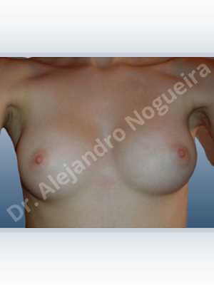 Asymmetric breasts,Cross eyed breasts,Small breasts,Anatomical shape,Inframammary incision,Subfascial pocket plane