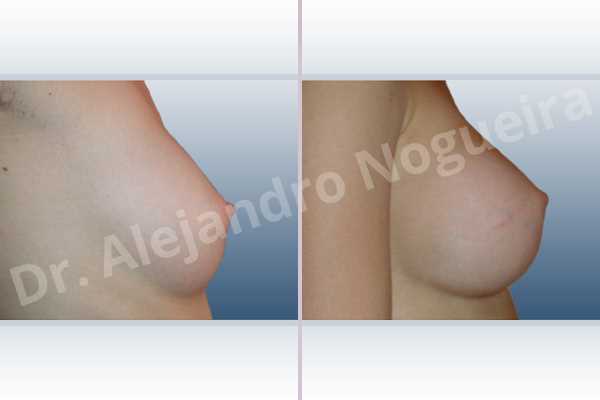 Asymmetric breasts,Cross eyed breasts,Small breasts,Anatomical shape,Inframammary incision,Subfascial pocket plane - photo 4