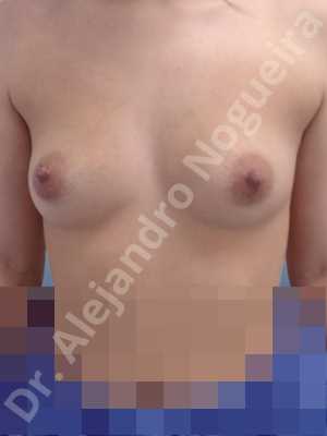 Asymmetric breasts,Cross eyed breasts,Empty breasts,Small breasts,Anatomical shape,Lower hemi periareolar incision,Subfascial pocket plane