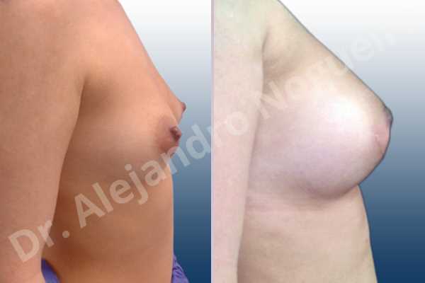 Asymmetric breasts,Cross eyed breasts,Empty breasts,Small breasts,Anatomical shape,Lower hemi periareolar incision,Subfascial pocket plane - photo 4