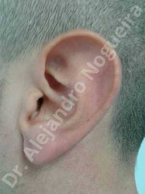 Large earlobes,Large ears,Prominent earlobes,Prominent ears,Fleur de lis cephalic ear resection,L shape earlobe resection