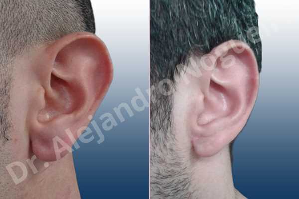 Large earlobes,Large ears,Prominent earlobes,Prominent ears,Fleur de lis cephalic ear resection,L shape earlobe resection - photo 3