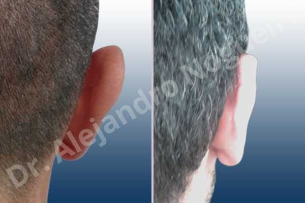 Large earlobes,Large ears,Prominent earlobes,Prominent ears,Fleur de lis cephalic ear resection,L shape earlobe resection - photo 8