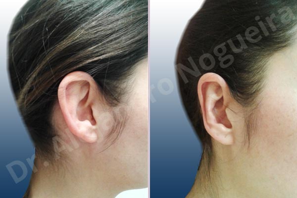 Prominent ears,Mustardé antihelical suturing - photo 5
