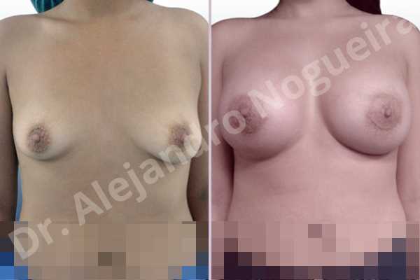 Empty breasts,Lateral breasts,Slightly saggy droopy breasts,Small breasts,Too far apart wide cleavage breasts,Wide breasts,Anatomical shape,Lower hemi periareolar incision,Subfascial pocket plane - photo 1