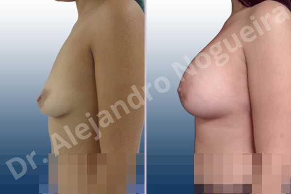 Empty breasts,Lateral breasts,Slightly saggy droopy breasts,Small breasts,Too far apart wide cleavage breasts,Wide breasts,Anatomical shape,Lower hemi periareolar incision,Subfascial pocket plane - photo 2