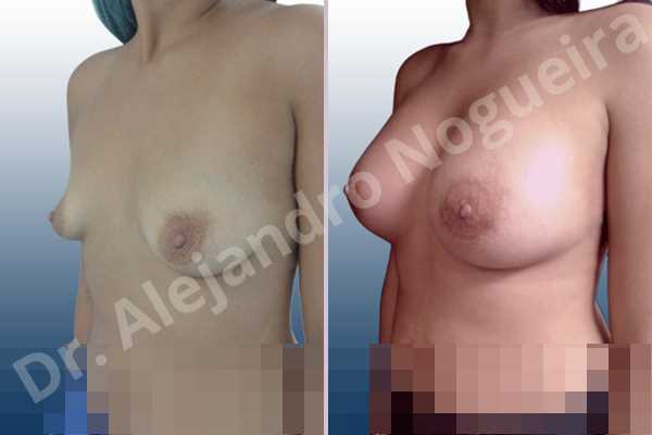 Empty breasts,Lateral breasts,Slightly saggy droopy breasts,Small breasts,Too far apart wide cleavage breasts,Wide breasts,Anatomical shape,Lower hemi periareolar incision,Subfascial pocket plane - photo 3