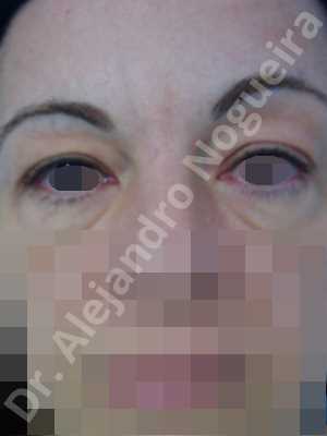 Baggy upper eyelids,Saggy upper eyelids,Upper eyelid fat bags resection,Upper eyelid skin and muscle resection