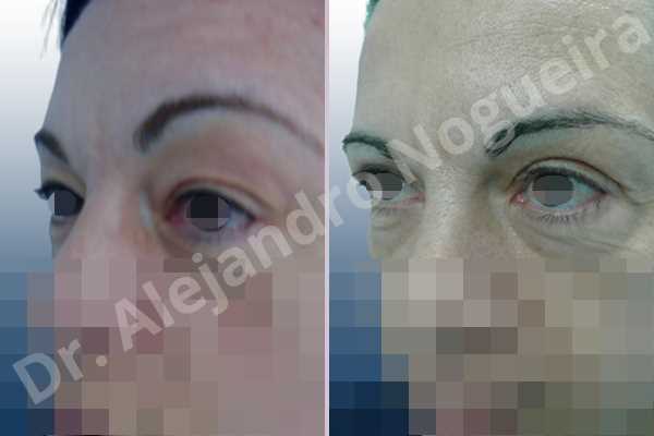 Baggy upper eyelids,Saggy upper eyelids,Upper eyelid fat bags resection,Upper eyelid skin and muscle resection - photo 4
