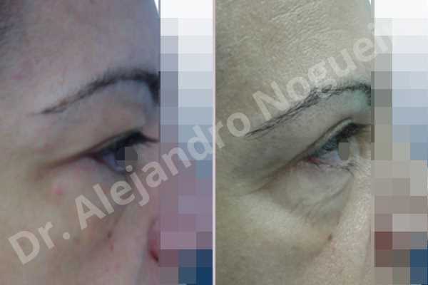 Before & After Case NFMB9GHM