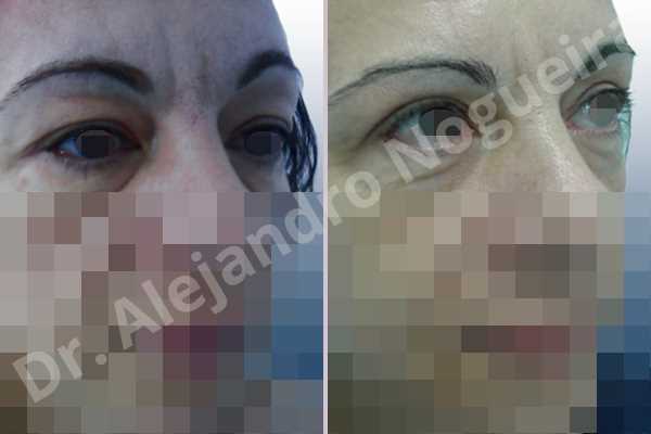 Before & After Case NFMB9GHM