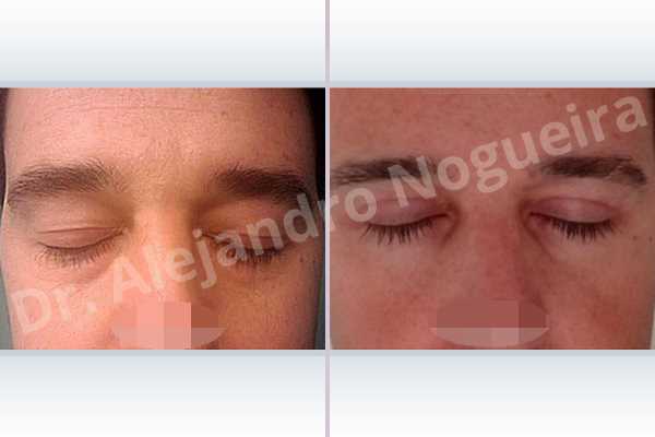 Baggy lower eyelids,Lower eyelid fat bags resection,Transconjunctival approach incision - photo 2