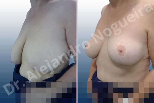 Asymmetric breasts,Breast tissue bottoming out,Cross eyed breasts,Extremely saggy droopy breasts,Lateral breasts,Moderately large breasts,Pendulous breasts,Pigeon chest,Too far apart wide cleavage breasts,Wide breasts,Tuberous breasts,Anchor incision,Double vertical pedicle - photo 3