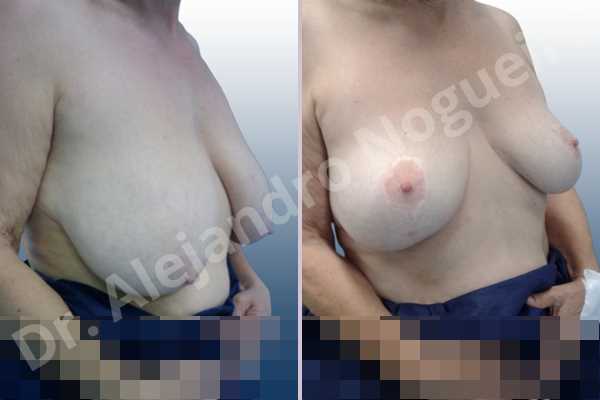 Asymmetric breasts,Breast tissue bottoming out,Cross eyed breasts,Extremely saggy droopy breasts,Lateral breasts,Moderately large breasts,Pendulous breasts,Pigeon chest,Too far apart wide cleavage breasts,Wide breasts,Tuberous breasts,Anchor incision,Double vertical pedicle - photo 5