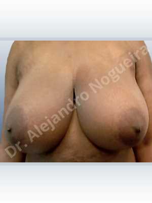 Asymmetric breasts,Extremely large breasts,Extremely saggy droopy breasts,Large areolas,Lateral breasts,Wide breasts,Anchor incision,Double vertical pedicle