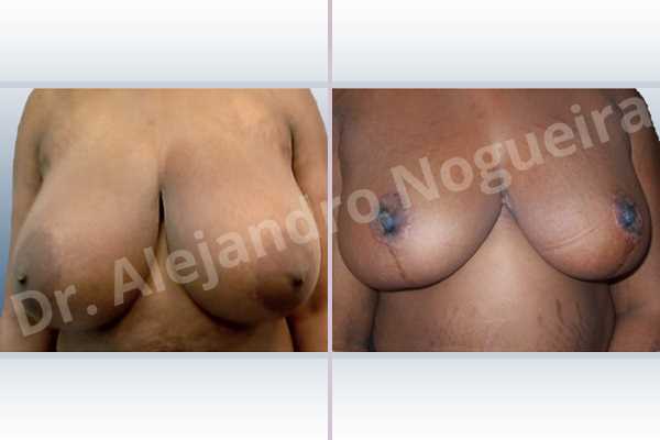 Asymmetric breasts,Extremely large breasts,Extremely saggy droopy breasts,Large areolas,Lateral breasts,Wide breasts,Anchor incision,Double vertical pedicle - photo 1