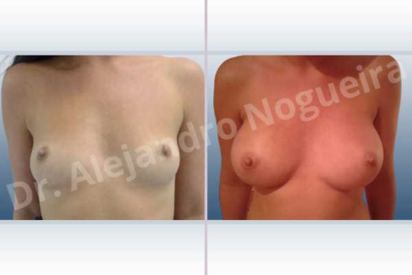 Cross eyed breasts,Empty breasts,Lateral breasts,Narrow breasts,Skinny breasts,Small breasts,Sunken chest,Too far apart wide cleavage breasts,Anatomical shape,Inframammary incision,Subfascial pocket plane - photo 1