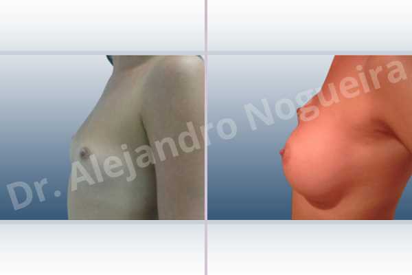 Cross eyed breasts,Empty breasts,Lateral breasts,Narrow breasts,Skinny breasts,Small breasts,Sunken chest,Too far apart wide cleavage breasts,Anatomical shape,Inframammary incision,Subfascial pocket plane - photo 2