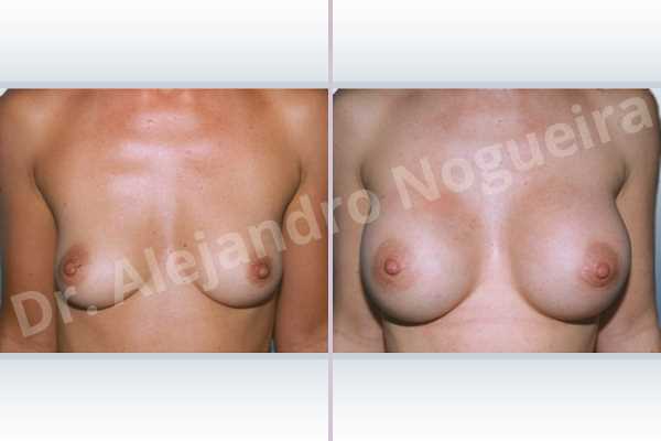 Asymmetric breasts,Cross eyed breasts,Empty breasts,Lateral breasts,Skinny breasts,Slightly saggy droopy breasts,Small breasts,Anatomical shape,Lower hemi periareolar incision,Subfascial pocket plane - photo 1