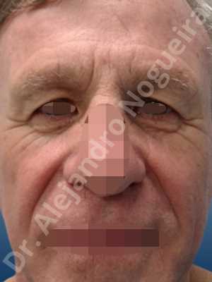 Baggy lower eyelids,Baggy upper eyelids,Deep nasolabial folds,Droopy cheeks,Droopy eyebrows,Droopy face,Droopy forehead,Saggy lower eyelids,Saggy upper eyelids,Upper eyelids ptosis,Lower eyelid fat bags resection,Lower eyelid skin and muscle resection,Lower eyelid wedge resection,Short temporal incisions supraperiosteal extended lift of the upper two thirds of the face,Subciliary approach incision,Upper eyelid fat bags resection,Upper eyelid skin and muscle resection
