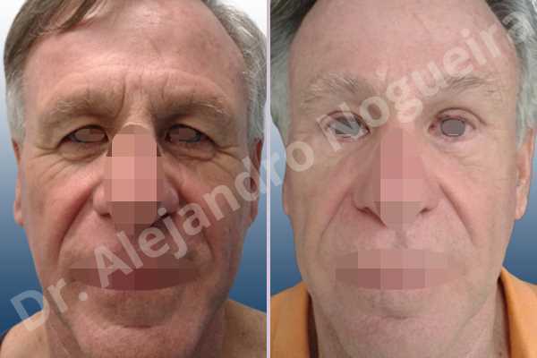 Baggy lower eyelids,Baggy upper eyelids,Deep nasolabial folds,Droopy cheeks,Droopy eyebrows,Droopy face,Droopy forehead,Saggy lower eyelids,Saggy upper eyelids,Upper eyelids ptosis,Lower eyelid fat bags resection,Lower eyelid skin and muscle resection,Lower eyelid wedge resection,Short temporal incisions supraperiosteal extended lift of the upper two thirds of the face,Subciliary approach incision,Upper eyelid fat bags resection,Upper eyelid skin and muscle resection - photo 1