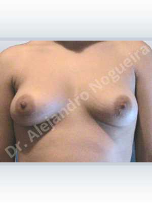 Asymmetric breasts,Empty breasts,Mildly saggy droopy breasts,Slightly saggy droopy breasts,Anatomical shape,Lower hemi periareolar incision,Subfascial pocket plane