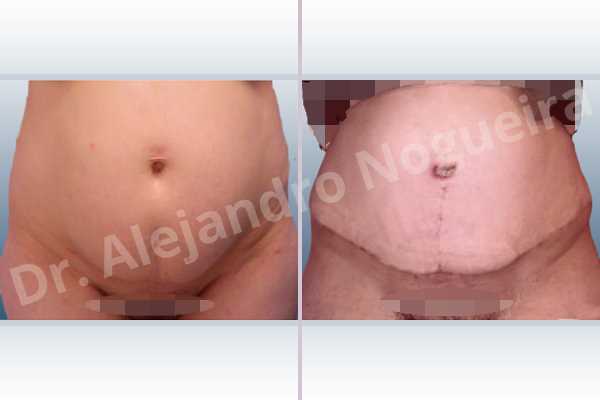 Saggy abdomen,Sunken scars,Weak abdomen muscles,Standard abdominoplasty - photo 1