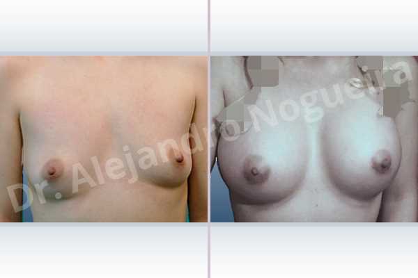 Asymmetric breasts,Empty breasts,Small breasts,Too far apart wide cleavage breasts,Anatomical shape,Extra large size,Lower hemi periareolar incision,Subfascial pocket plane - photo 1