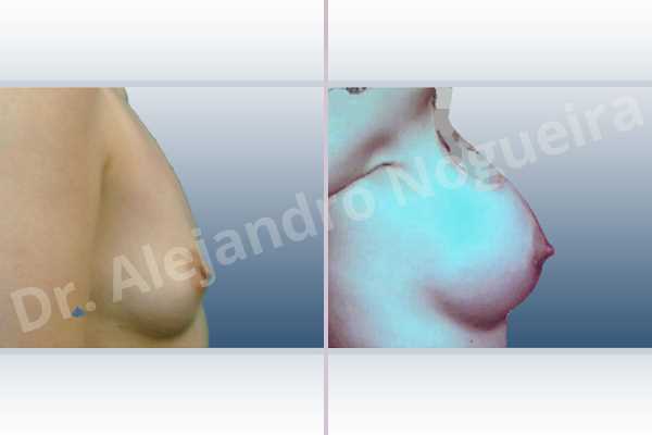 Asymmetric breasts,Empty breasts,Small breasts,Too far apart wide cleavage breasts,Anatomical shape,Extra large size,Lower hemi periareolar incision,Subfascial pocket plane - photo 4