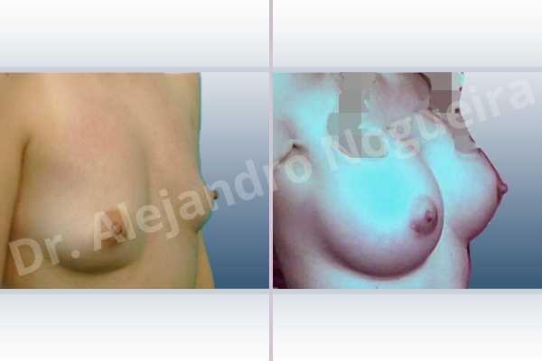 Asymmetric breasts,Empty breasts,Small breasts,Too far apart wide cleavage breasts,Anatomical shape,Extra large size,Lower hemi periareolar incision,Subfascial pocket plane - photo 5