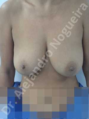Asymmetric breasts,Empty breasts,Moderately large breasts,Pendulous breasts,Severely saggy droopy breasts,Wide breasts,Anatomical shape,Extra large size,Lower hemi periareolar incision,Subfascial pocket plane