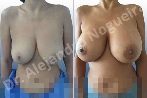 Asymmetric breasts,Empty breasts,Moderately large breasts,Pendulous breasts,Severely saggy droopy breasts,Wide breasts,Anatomical shape,Extra large size,Lower hemi periareolar incision,Subfascial pocket plane - photo 1