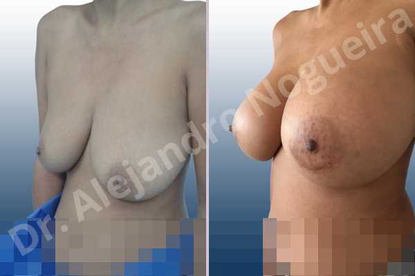 Asymmetric breasts,Empty breasts,Moderately large breasts,Pendulous breasts,Severely saggy droopy breasts,Wide breasts,Anatomical shape,Extra large size,Lower hemi periareolar incision,Subfascial pocket plane - photo 3